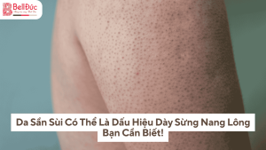 Da Sần Sùi Có Thể Là Dấu Hiệu Dày Sừng Nang Lông - Bạn Cần Biết!